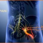 Sciatica nerve