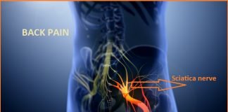 Sciatica nerve PICTURE