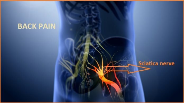 Sciatica nerve PICTURE